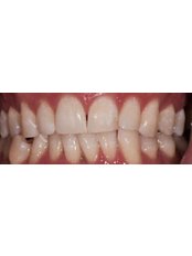 Zoom! Teeth Whitening - IKON Dental Specialists