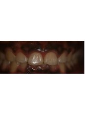 Crown Lengthening - IKON Dental Specialists