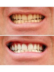 Teeth Whitening - Keep Smiling Dental Practice