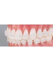 Ceramic Braces - Keep Smiling Dental Practice