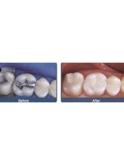 White Filling - Keep Smiling Dental Practice