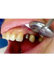 Dental Implants - Keep Smiling Dental Practice