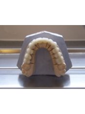 Dental Crowns - Keep Smiling Dental Practice
