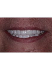 Zirconia - metal free - Lovesmile - Dental Implant and Cosmetic Centre