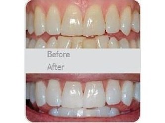 First Impressions Last Teeth Whitening