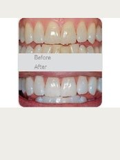 First Impressions Last Teeth Whitening - before/after
