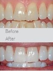 First Impressions Last Teeth Whitening - before/after 