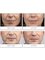 Dental Spa 25 - Dermal Filler Treatment at Dental Spa 25 