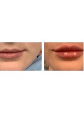 Lip Augmentation - The Dinnington Practice