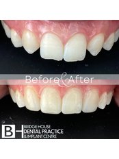 Dental Bonding - Bridge House Dental Practice & Implant Centre