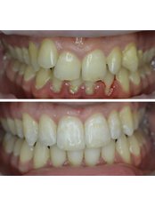 Braces (per arch) - Carew Dental Limited