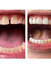 Dental Bridges (per tooth) - Carew Dental Limited