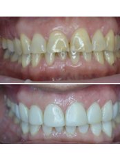 Composite Veneers (per tooth) - Carew Dental Limited