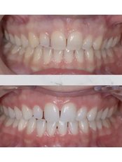 Teeth Whitening - Avenue Dental