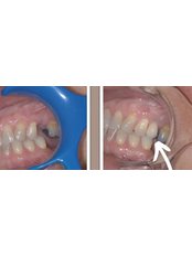 Dental Implants - Avenue Dental