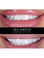 Multiple Veneers - All Saints Implant and Dental Specialist Clinic