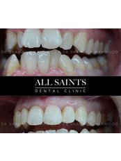 Invisalign™ GO - All Saints Implant and Dental Specialist Clinic