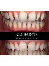Glow White Air Abrasion - All Saints Implant and Dental Specialist Clinic