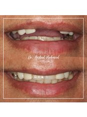 Dental Implants - Spencer Road Dental Surgery