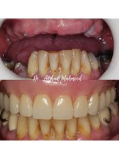 Dentures - Spencer Road Dental Surgery