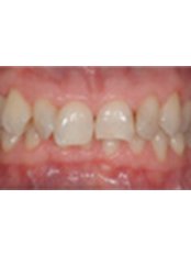 Veneers - Changing Faces Dentistry and Facial Rejuvenation -Knowle House