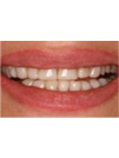 Crown (metal free) - Changing Faces Dentistry and Facial Rejuvenation -Knowle House