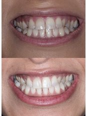 Teeth Whitening - Halfway House Dental