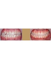 Invisalign™ - Halfway House Dental