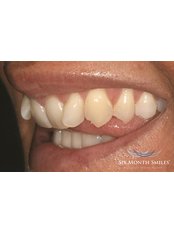 Six Month Smiles™ - Aesthetique Dental Care