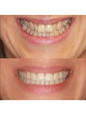 Invisalign™- Lite top and bottom teeth - HQ Dental