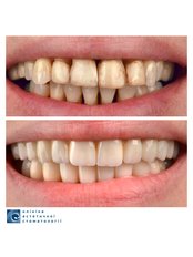 All-on-6 Dental implants (per one jaw) - Clinic of Aesthetic Dentistry