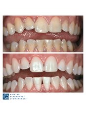 Teeth Cleaning - Clinic of Aesthetic Dentistry