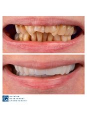 Permanent Crown - Clinic of Aesthetic Dentistry