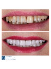 Dental Crowns - Clinic of Aesthetic Dentistry