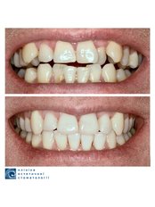 Adult Braces - Clinic of Aesthetic Dentistry