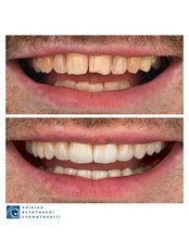 Porcelain Veneers - Clinic of Aesthetic Dentistry