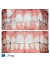 Metal Braces - Clinic of Aesthetic Dentistry