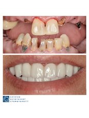 Full Mouth Rehabilitation - Clinic of Aesthetic Dentistry
