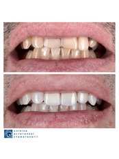 Zirconia Crown - Clinic of Aesthetic Dentistry