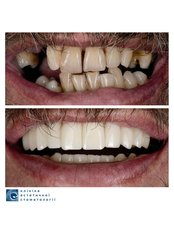 Full Mouth Rehabilitation - Clinic of Aesthetic Dentistry