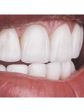 Whitening Top Up Treatment - Dental Clinic Dr.Korotkova