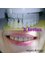 Dental Clinic Dr.Korotkova - crowns after 4 years 