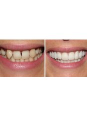 Veneers - Dynasty Dental Clinic - Park Avenue