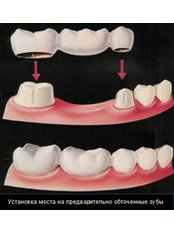 Dental Bridges - Dynasty Dental Clinic - Park Avenue