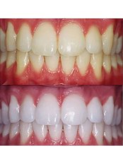 Teeth Whitening - Dynasty Dental Clinic - Park Avenue