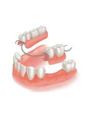 Dentures - Dynasty Dental Clinic - Park Avenue