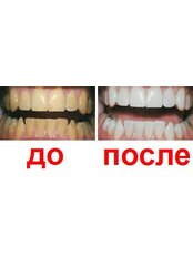Zoom! Teeth Whitening - Dynasty Dental Clinic - Park Avenue