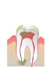 Endodontist Consultation - Dynasty Dental Clinic - Park Avenue