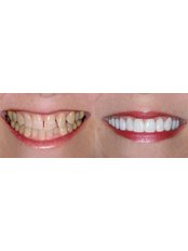 Lumineers™ 1 - Dynasty Dental Clinic - Park Avenue