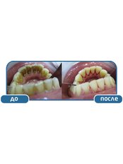 Teeth Cleaning - Dynasty Dental Clinic - Park Avenue